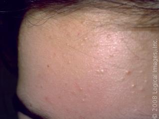 acne breakouts